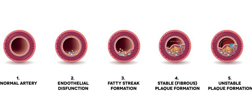 atherosclerosis formation.jpg s=1024x1024&w=is&k=20&c=VEkzWS2z4HWCjPZLhjfVZH4PdhIYp oUdlXmZaYyZTs=